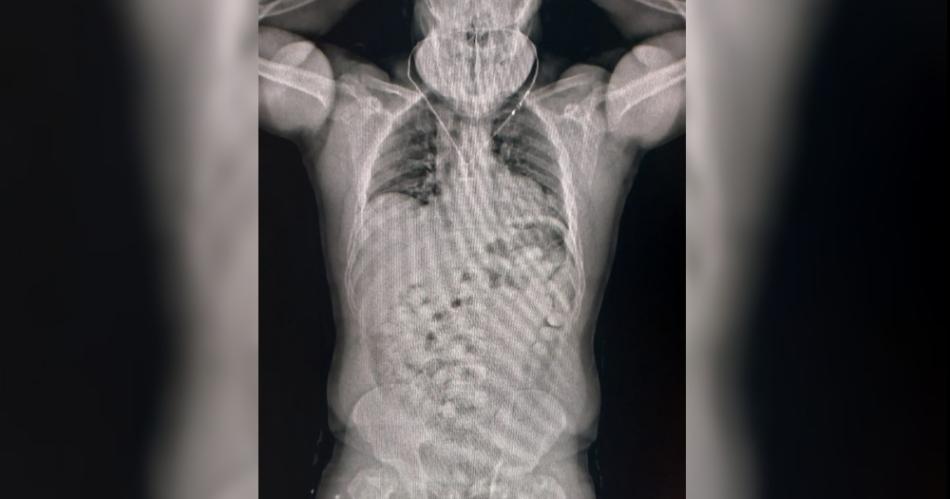 Habiacutea tragado maacutes de 80 caacutepsulas con cocaiacutena para no ser detectado pero falloacute