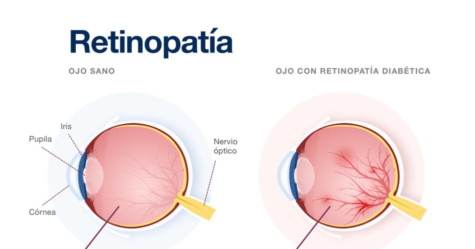 Los trastornos de la alimentacioacuten pueden aumentar el riesgo de retinopatiacutea diabeacutetica