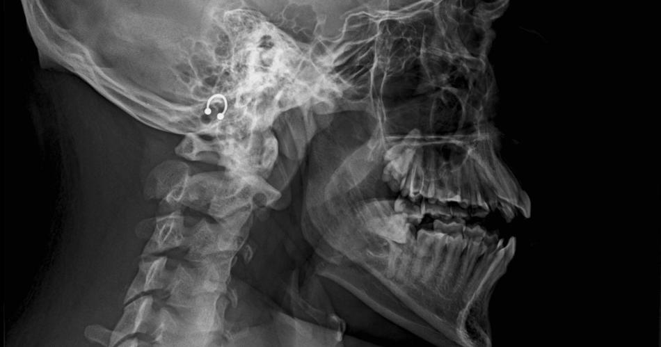 Fuacutetbol 5 salvaje- jugador con doble fractura de mandiacutebula