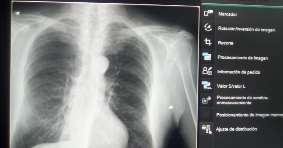 INFORMES- Las radiografías y placas confirmaron el temido diagnóstico