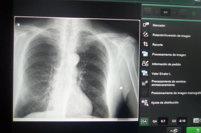 INFORMES- Las radiografías y placas confirmaron el temido diagnóstico